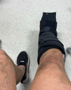 Image received of  Salford Red Devils Summer Harris' leg following the injury - via Summer Harris